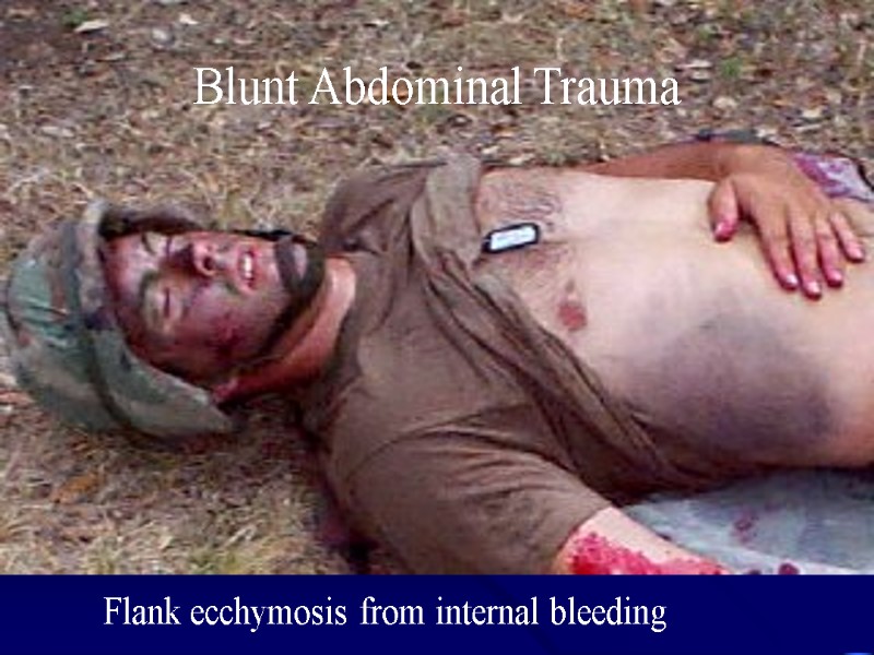 Blunt Abdominal Trauma Flank ecchymosis from internal bleeding